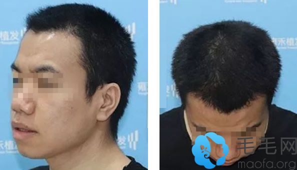 西安雍禾种植头发6个月效果