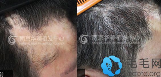 南京华美刘学习疤痕植发前后对比照片