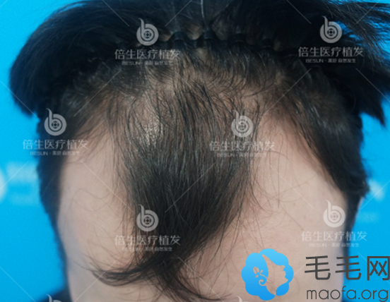 M型脱发男士用他在广州倍生头发种植的案例来验证医院坑不坑