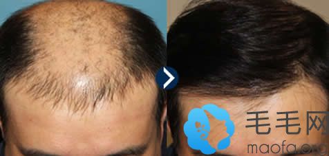 深圳希思整形六级脱发种植头发效果