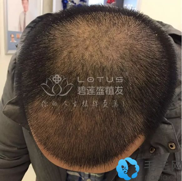在上海碧莲盛植发种植发际线20天效果