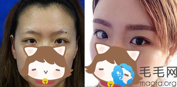 在杭州维多利亚植发中心做眉毛种植案例前后效果对比照片