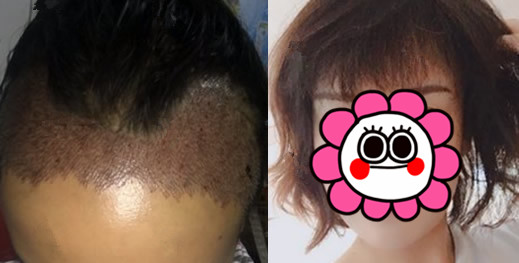 作为90后M脱发的女性,我选择在郑州陇海医院做了发际线种植