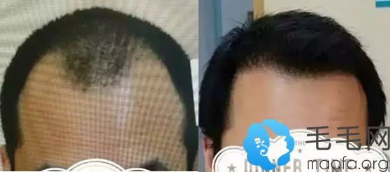M脱发在成都华西医院种植发际线种植前后对比