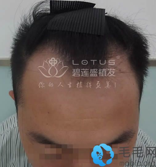 在上海碧莲盛植发种植头发术前照