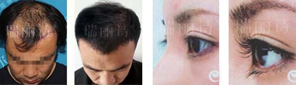 杭州瑞丽诗发际线种植+种植睫毛的效果案例