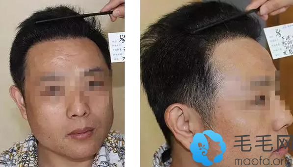 东莞雍禾种植头发6个月的恢复效果