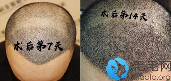 南宁科发源种植头发术后7-14天恢复过程图：