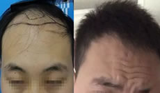别拦我 我就要看重庆雍禾的植发价格和代峰医生的案例图片