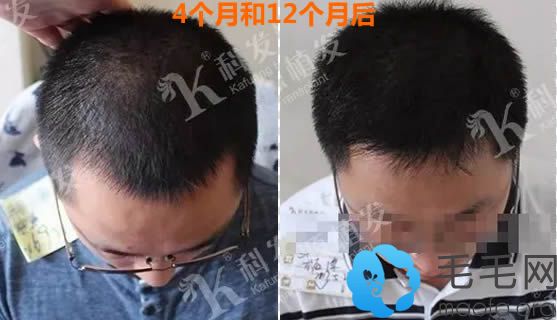 种植发际线和头顶加密12个月恢复效果