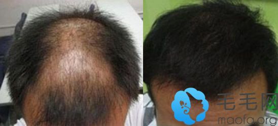 除了非那雄胺片外，植发也可以改善脱发问题