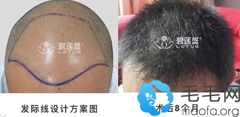 广州碧莲盛为大面积脱发男性种植头发案例