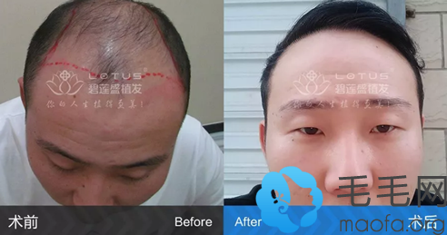 北京碧莲盛为五级脱发患者植发案例