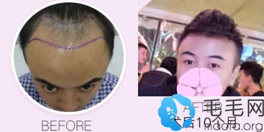 M型脱发男士在武汉五洲做发际线种植案例