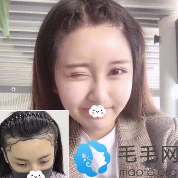 北京新面孔发际线种植真人案例效果前后对比