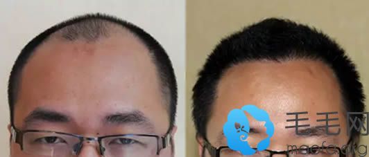 北京碧莲盛秃顶植发一年后恢复效果