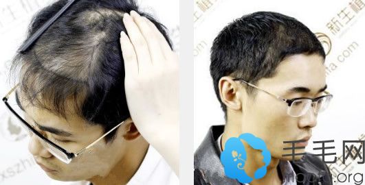 杭州新生头发加密植发效果怎么样