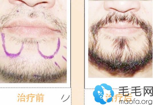 宁夏新面孔植发胡须种植案例对比图