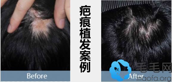 北京新面孔疤痕植发案例及术后8个月恢复效果图