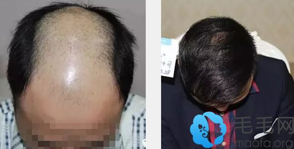 秃顶的张先生在上海雍禾植发效果好不好