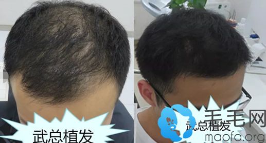 男性在武汉武总植发做头发种植案例