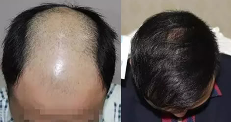 大家来看我的秃顶在哈尔滨博士园植发2600单位后1年效果行吗