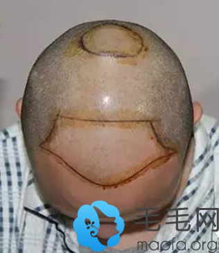 秃顶在哈尔滨博士园植发术前设计