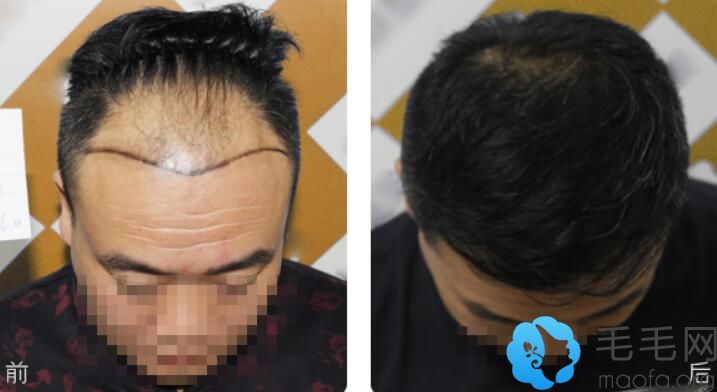 秃顶、M脱发等发友在济南名韩植发后公布自己的效果对比图