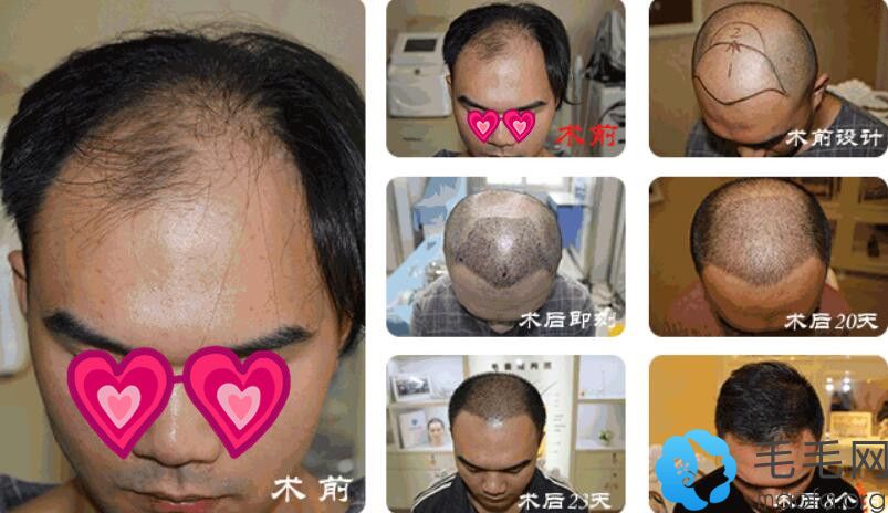 秃顶男士在科发源采用微针植发术后恢复过程及效果图对比