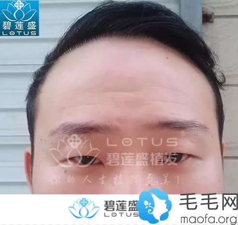 在北京碧莲盛植发10个月效果图