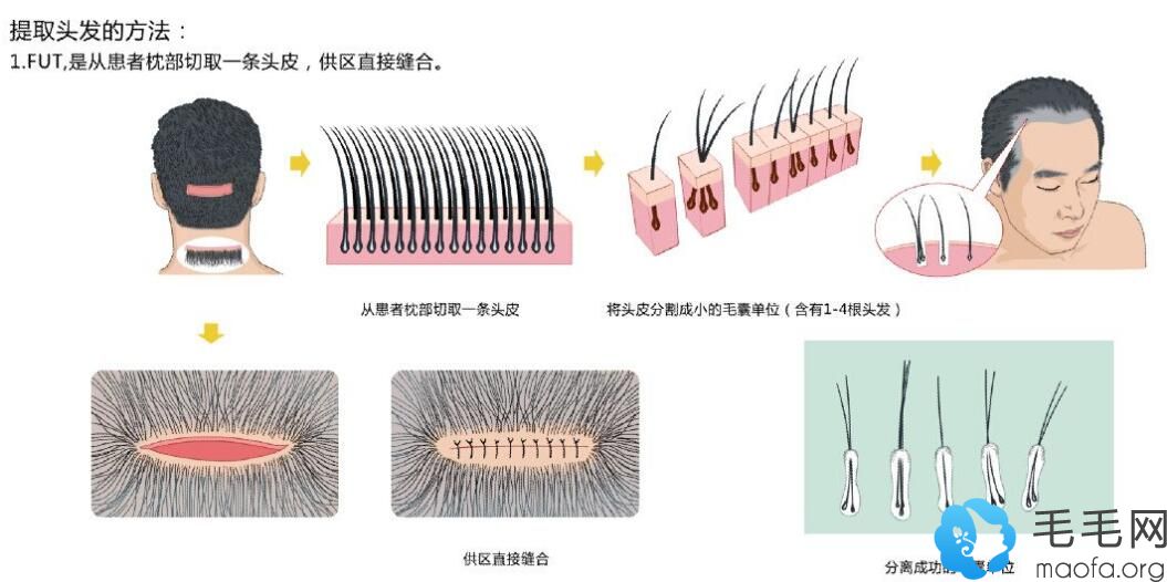 FUT“毛囊单位线性头皮移植术”