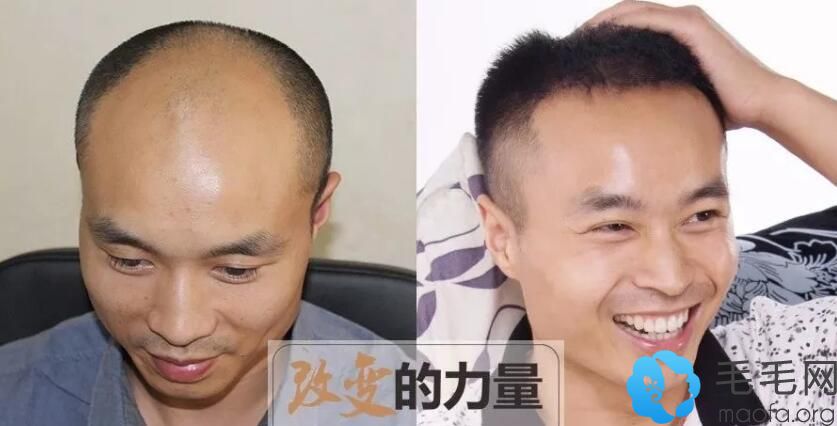 5级脱发需要多少毛囊？北京碧莲盛5级脱发种植4000单位照片