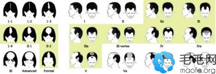艾培拉软激光生发头盔治疗主要针对哪些脱发人群