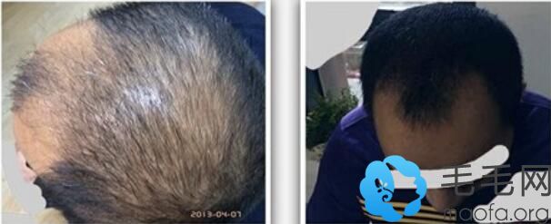 83年男性使用艾培拉治疗脱发前后效果对比
