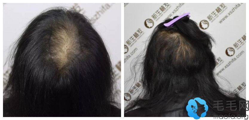 头发少能加密种植吗？来看广州新生头顶加密植发术前术后对比案例