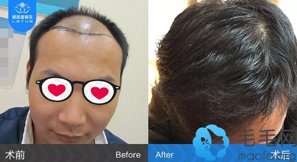 北京碧莲盛植发一年前后效果对比图