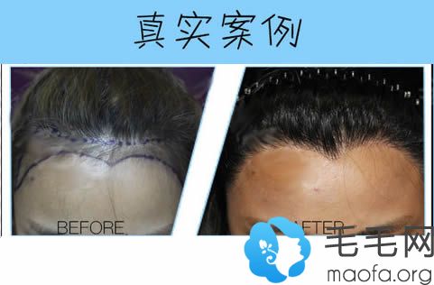 杭州维多利亚植发女性发际线移植前后对比照