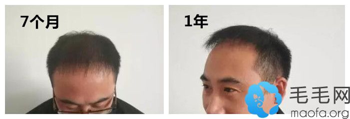 属于重庆瑞丽诗种植头发术后7个月及1年效果图