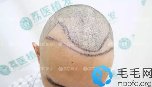 广州荔医植发设计植发方案