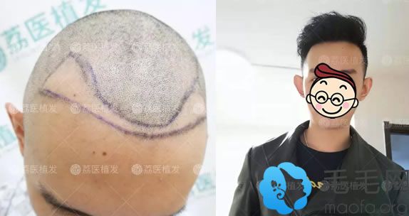 广州荔医种植发际线案例对比图