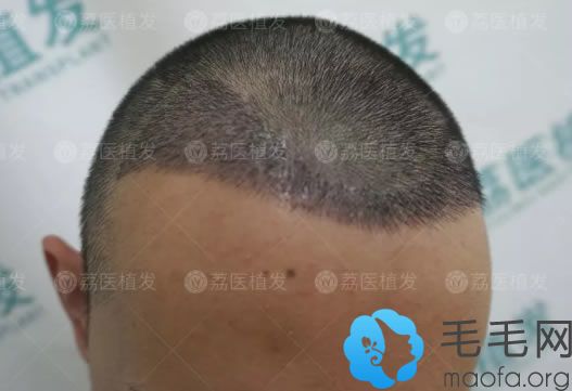 广州荔医植发15天恢复效果图