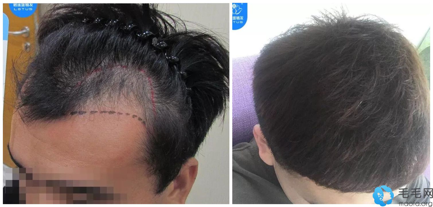 遗传性M型脱发男士在碧莲盛做发际线种植案例