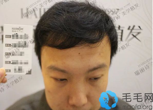 杭州瑞丽诗种植头发10个月的恢复效果怎么样