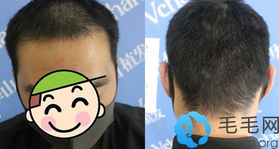 郑州华山医院植发科种植头发案例