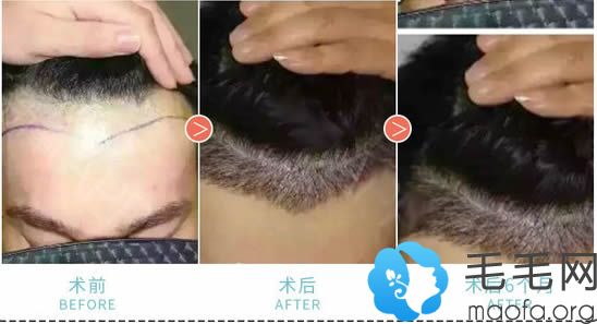 女性发际线过高植发2000毛囊单位6个月恢复效果