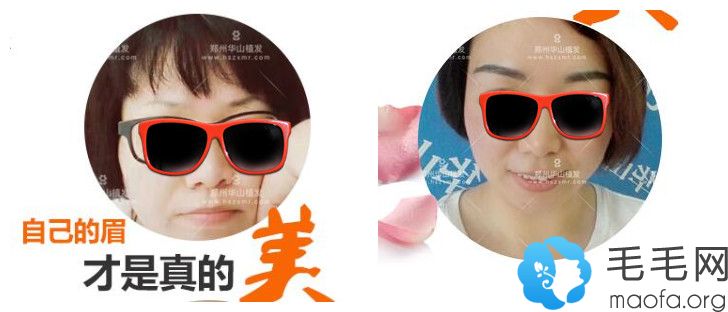 属于郑州医德佳医院的女性眉毛种植案例