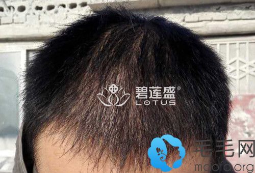 郑州碧莲盛种植头发术后6个月
