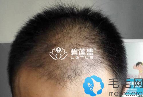 在郑州碧莲盛做头发种植术后3个恢复情况