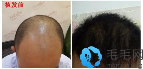 植发手术治疗头顶脱发6个月的效果