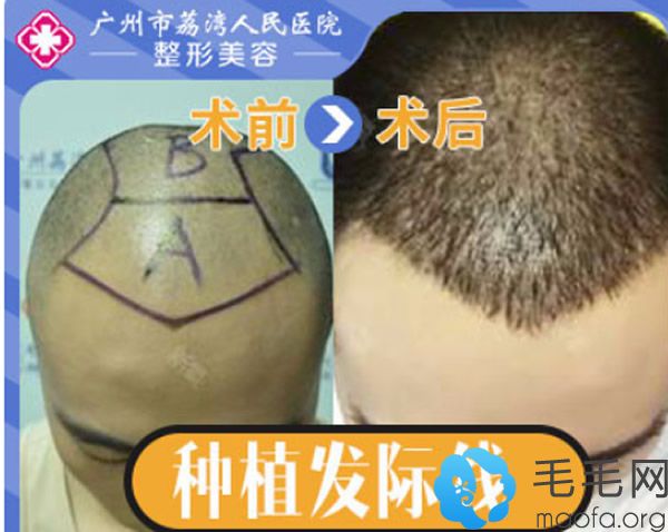 广州荔湾人民医院男士种植发际线+头顶加密植发图片